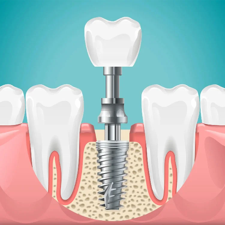implant image