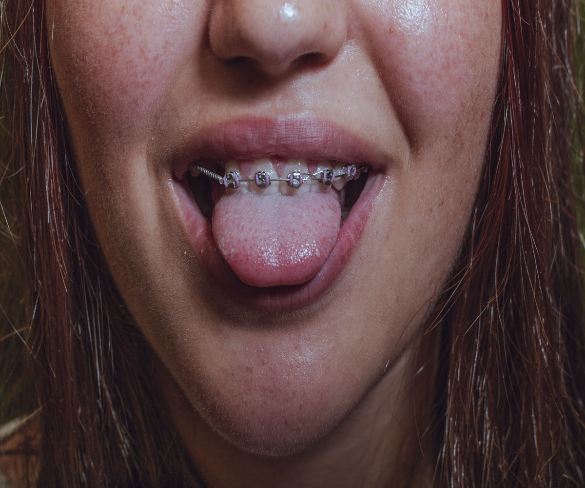 Close-up of a person with metal braces sticking out their tongue.