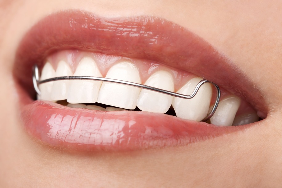 Close-up of teeth wearing an orthodontic retainer.